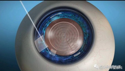 西安华厦眼科医院 半飞秒近视手术优缺点分析