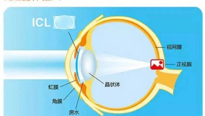 中山华厦眼科医院张弛教授：圆锥角膜可以做ICL晶体植入手术吗？