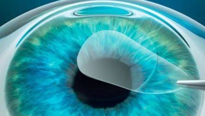 中山华厦张弛教授：做完近视手术视力能达到多少？