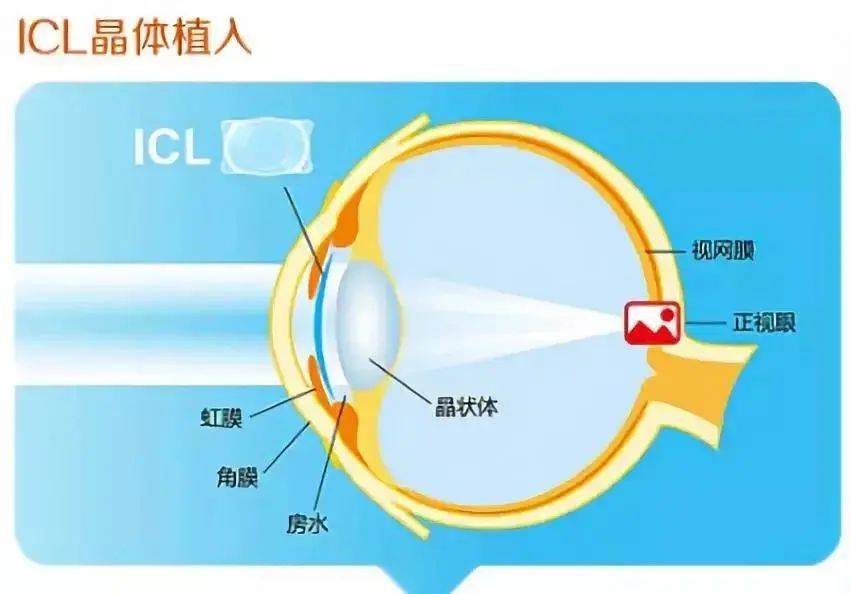 中山华厦眼科医院张弛教授：圆锥角膜可以做ICL晶体植入手术吗？